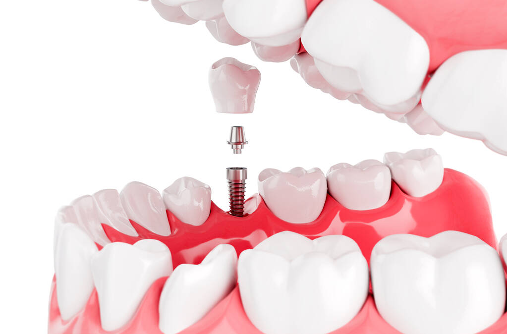 Cost of dental implants in Perth, WA dental implants in Perth, WA