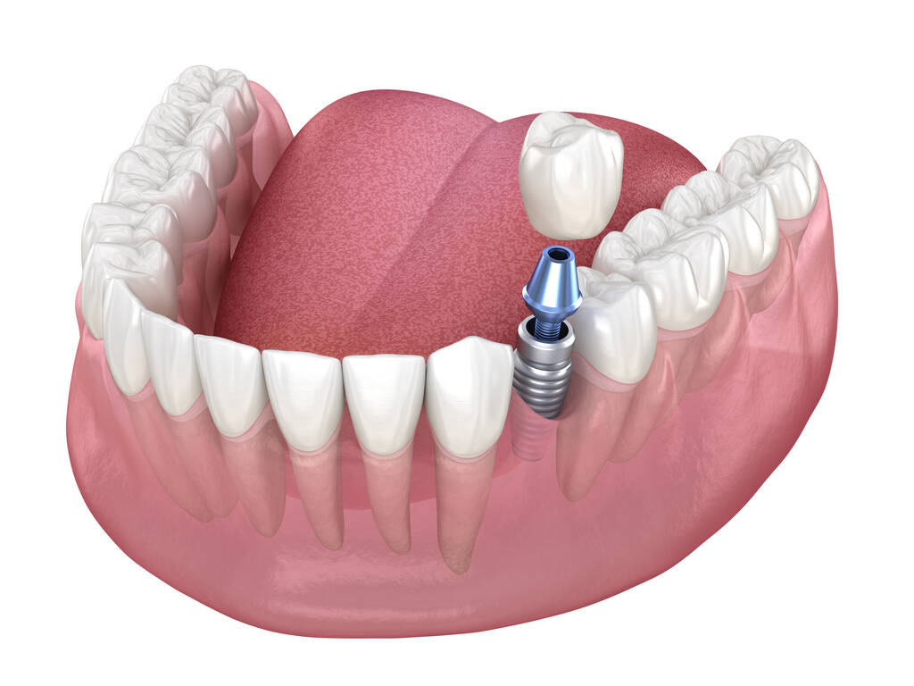 What To Expect From A Dental Implant Procedure