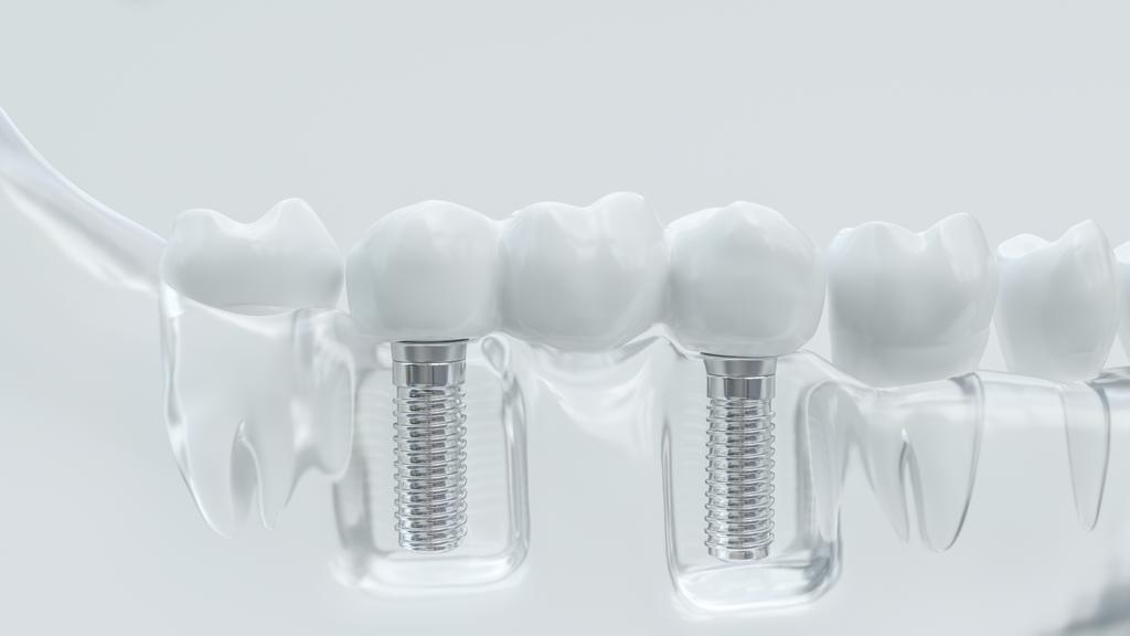 dental implants