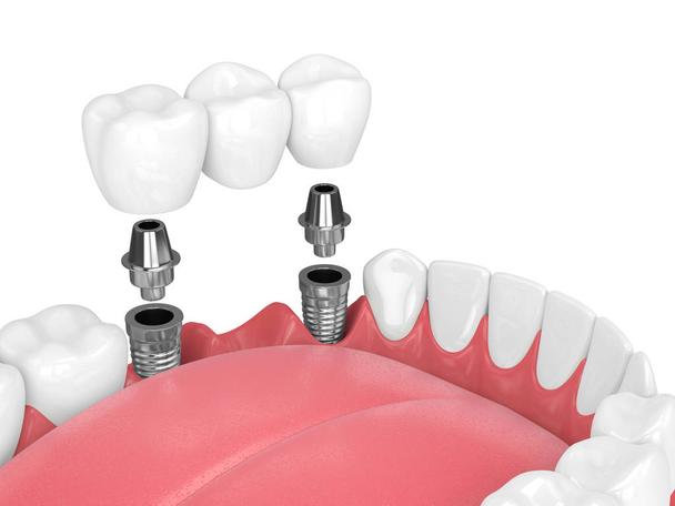 Implant-Retained Dentures in Perth