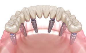 What Is The Most Recent Innovation In Dental Implants